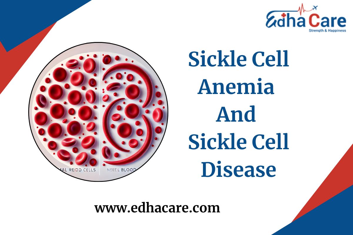 Sickle Cell Anemia And Sickle Cell Disease: The Detail Guide