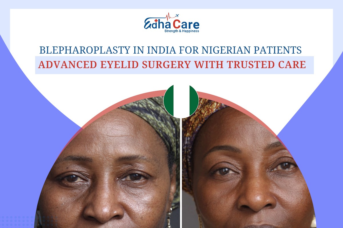 Blepharoplasty in India for Nigerian Patients