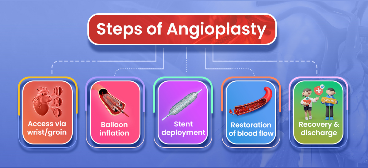 angioplasty steps