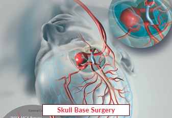 Skull Base Surgery In India