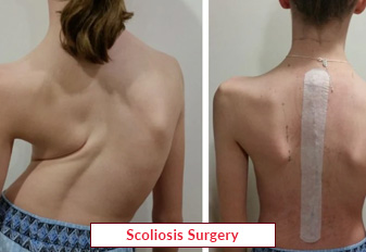 Scoliosis Spine Surgery In India