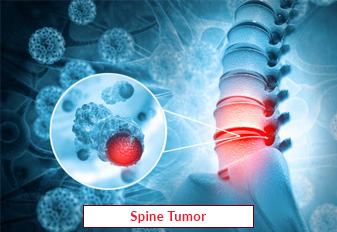 Spine Tumor Surgery In India