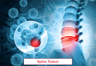 Cirurgia de tumor de coluna na Índia