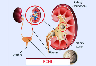 Cirugía de nefrolitotomía percutánea (NLPC) en la India