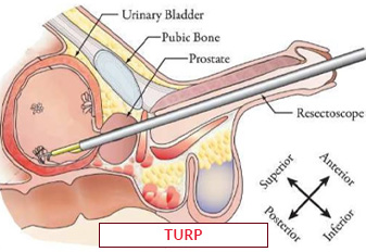 TURP Surgery In India