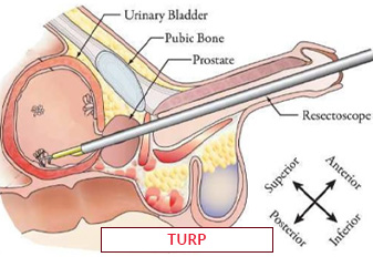 جراحة TURP في الهند