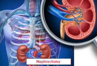 Nephrectomy Surgery In India