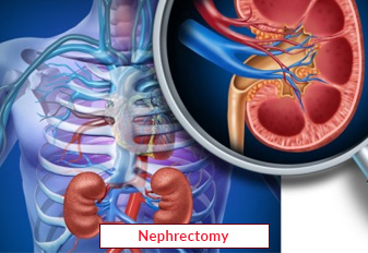 Nephrectomy Chirurgie in Indië