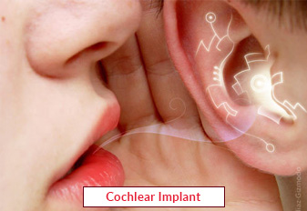 Cochlear Implant Surgery in India