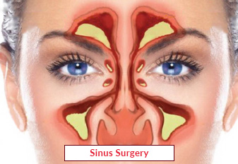 Эндоскопическая хирургия носовых пазух в Индии