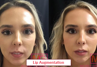 Lip Augmentation Treatment In India