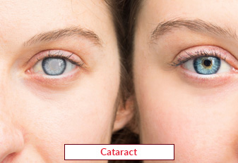 Cataract Surgery In India