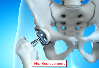 Hip Replacement Surgery In India