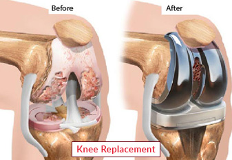 Cirugía de reemplazo de rodilla en India