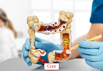 Kryochirurgie in Indien