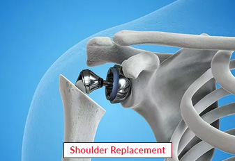 Shoulder Replacement Surgery In India