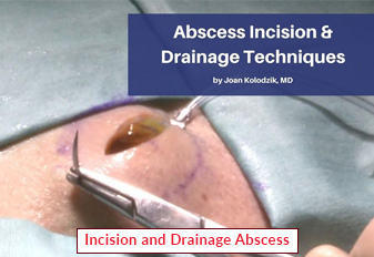 Incision and Drainage Abscess
