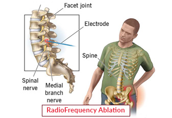 Radiofrequenzablation