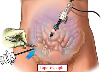 Cirugía laparoscópica