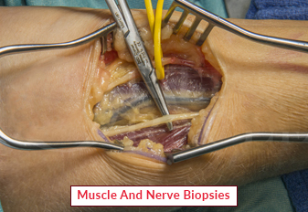 Muscle And Nerve Biopsies