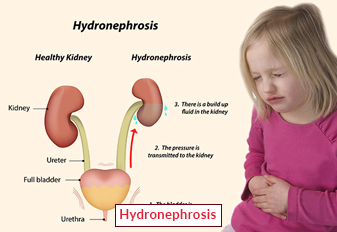 Hydronephrosis Treatment
