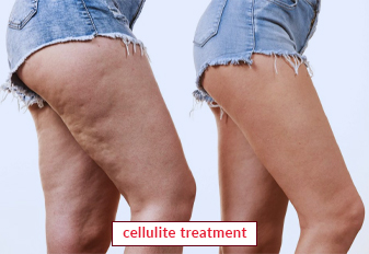 Cellulite Treatment