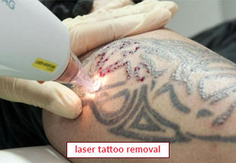Update more than 63 advanced tattoo removal best - vova.edu.vn