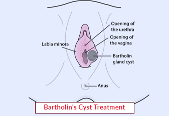 Bartholin's Cyst Treatment