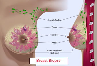 Breast Biopsy