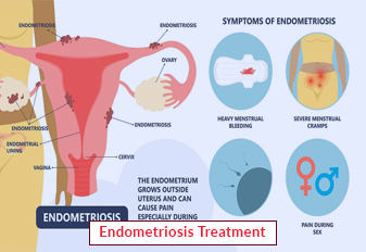 Traitement de l'endométriose : diagnostic et procédure