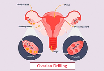 Forage ovarien laparoscopique (diathermie ovarienne) pour le SOPK