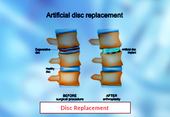 Disc Replacement