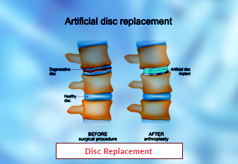 Substituição de disco