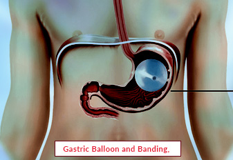 Balon Gastric