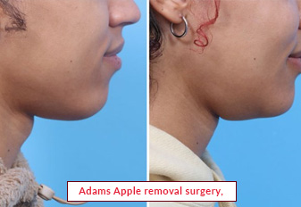 Adams Apple removal surgery