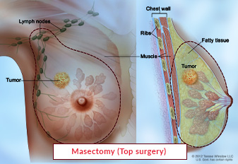 Masectomy (Top surgery)
