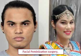 Facial Feminization surgery