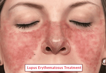 Lupus érythémateux