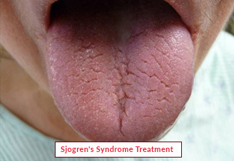 Tratamiento del síndrome de Sjogren