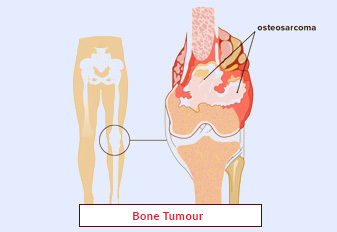 Traitement des tumeurs osseuses : types, causes et symptômes