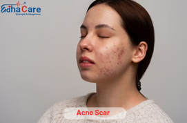 Cicatriz de acne
