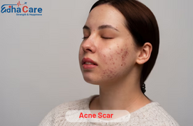 Acne Scar