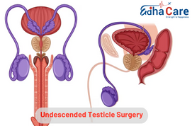 Onafgedaalde testikelchirurgie