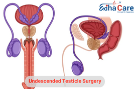 Chirurgie testiculaire non descendue