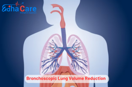 Redução do volume pulmonar broncoscópico