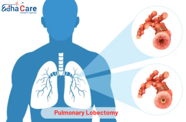 Lobectomie pulmonară