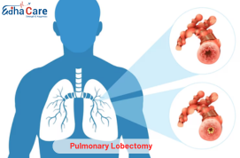 Pulmoner Lobektomi