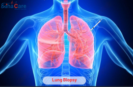 Lung Biopsy