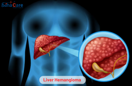 Hemangioma hepático