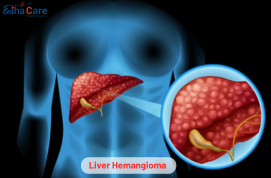 Hemangioma van die lewer